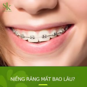 Niềng răng mất bao lâu?