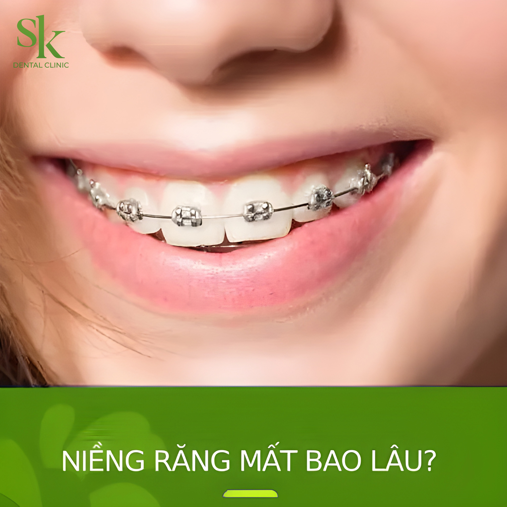 Niềng răng mất bao lâu?