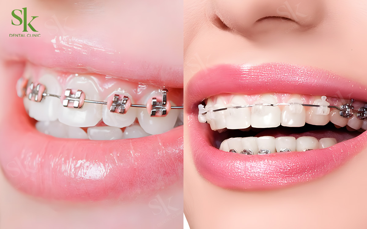 Giá Niềng răng 1 hàm – 2 hàm