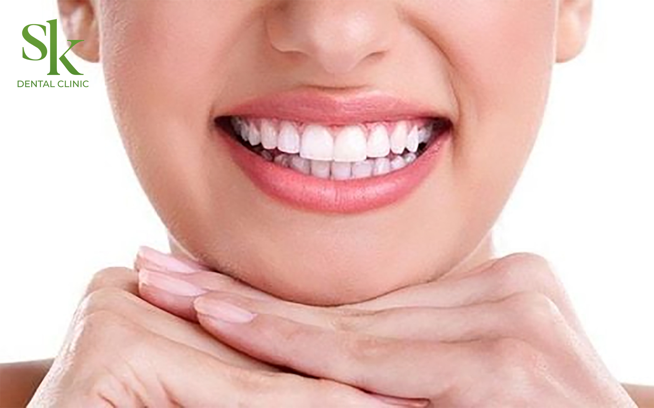 Niềng răng đem lại nhiều lợi ích tuyệt vời