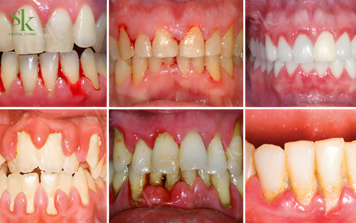 Không niềng khi viêm lợi, sâu răng chưa điều trị dứt điểm