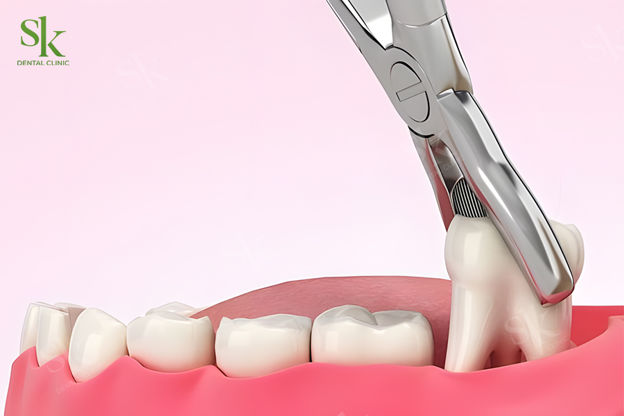 Không phải ai niềng răng cũng cần nhổ răng