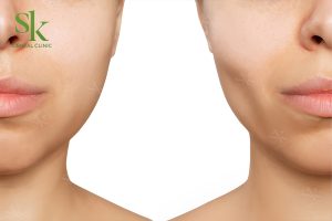 Niềng răng có bị hóp má không?