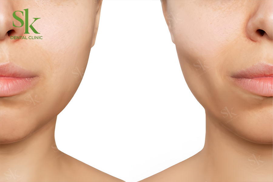 Niềng răng có bị hóp má không?