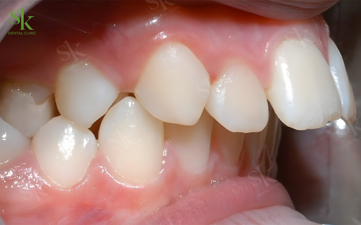 Người có răng hô - vẩu nặng