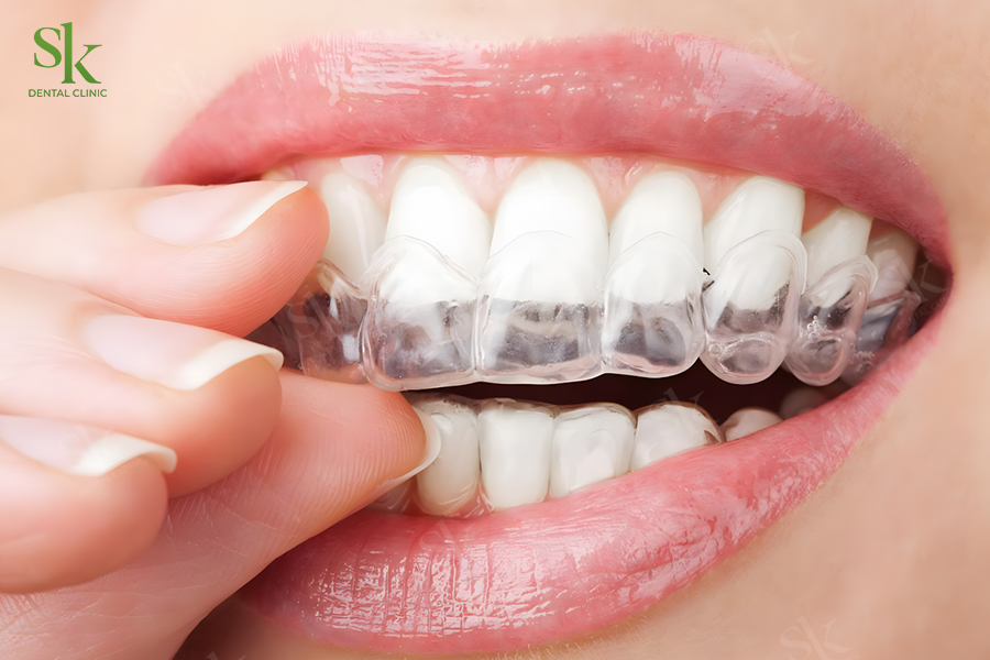 Invisalign sử dụng hệ thống khay niềng nhựa trong suốt để di chuyển răng
